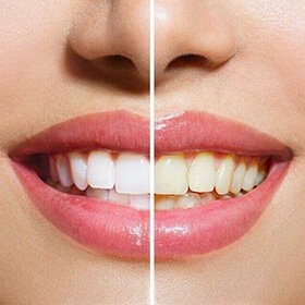 diş beyazlatma işlemi