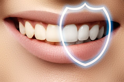 diş beyazlatma tedavisi