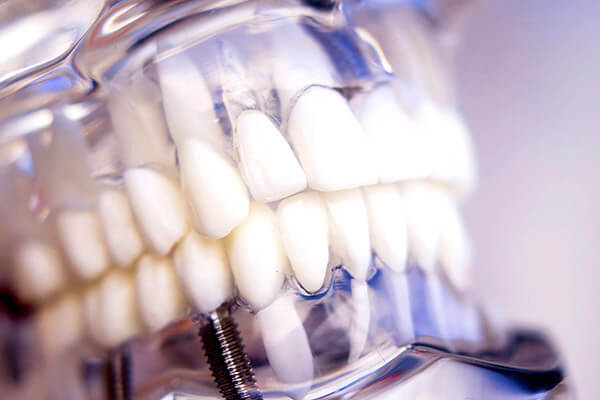 diş implantı tedavisi