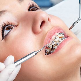 diş teli tedavisi uygulama