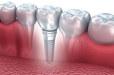 implant diş tedavisi