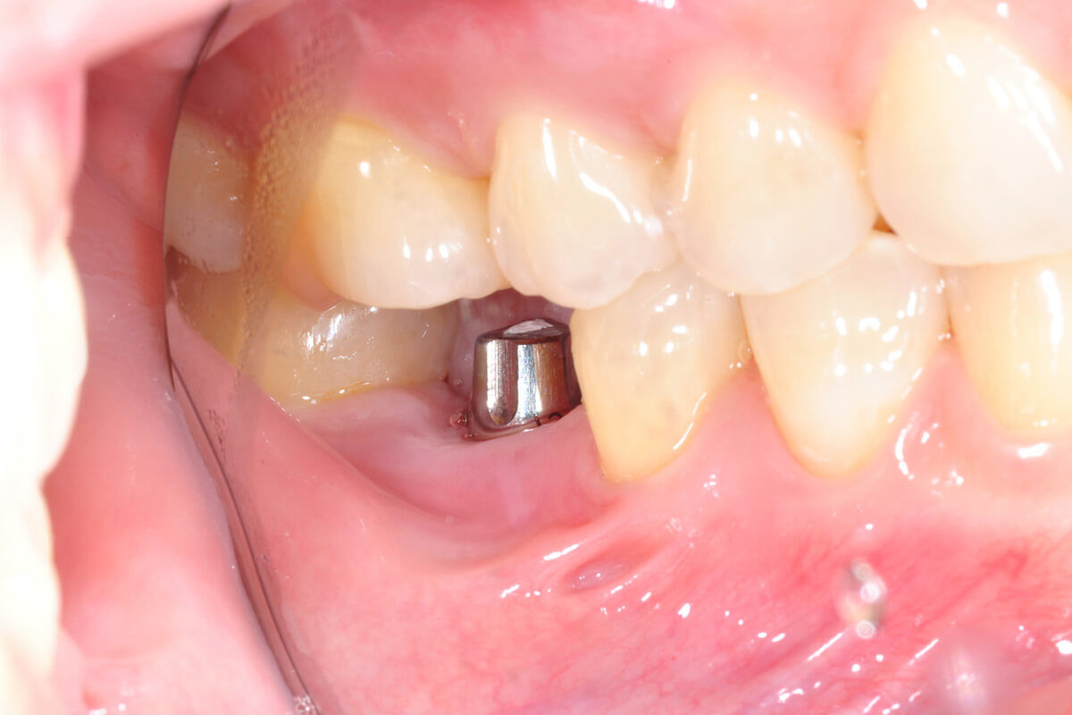kısmi-diş-implantı-1200x800.jpg
