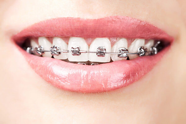 ortodonti diş teli tedavisi