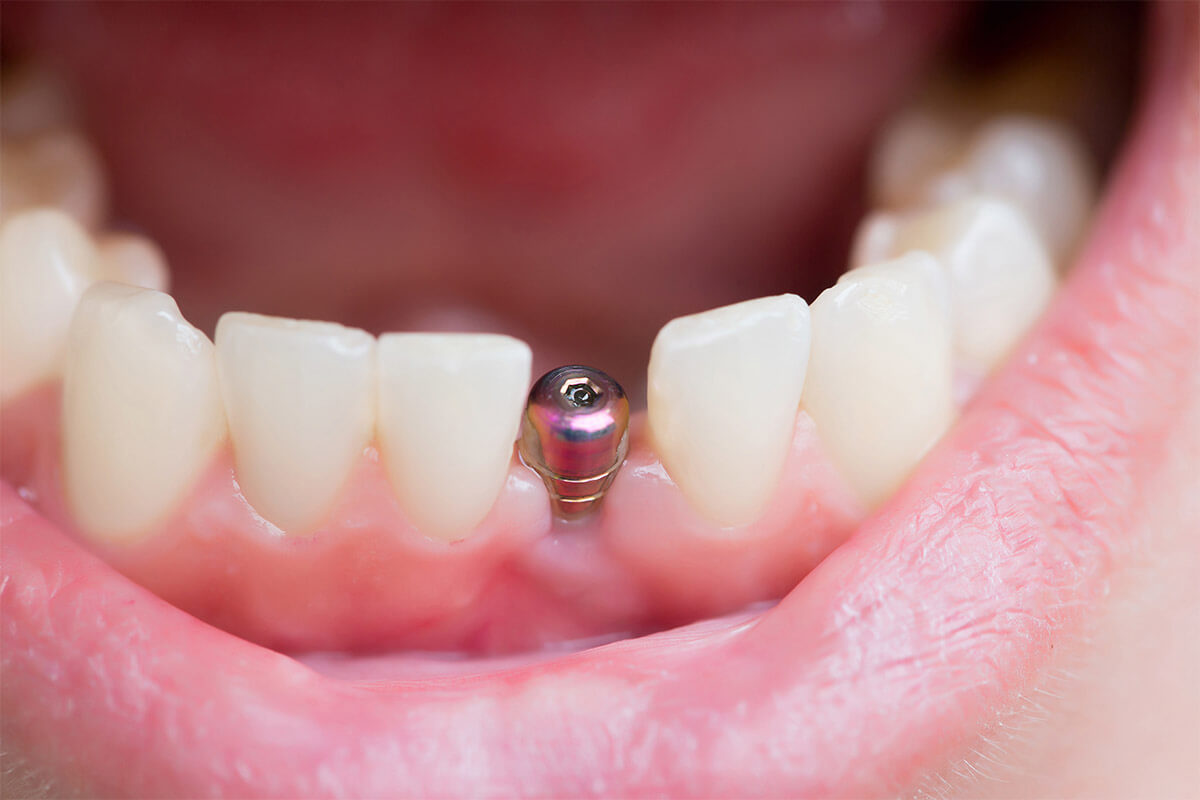 tek-diş-eksikliğinde-implant-1200x800.jpg