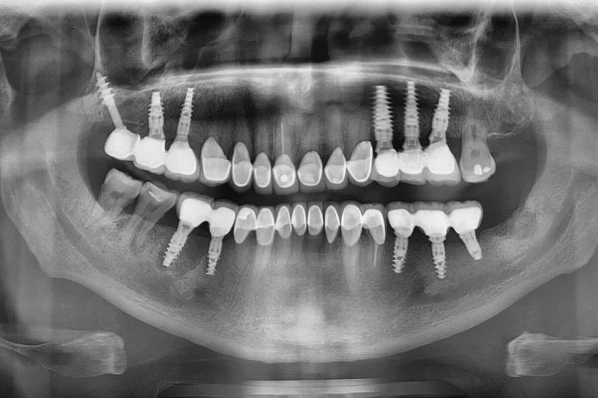 total-diş-kaybı-implantı-1200x800.jpg